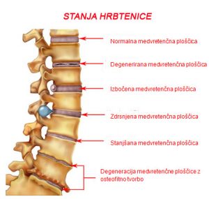 Protruzija diska in ostale okvare hrbtenice